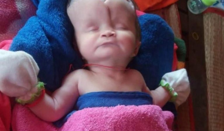 Girl Born With Missing Skull Defies The Odds to Survive
