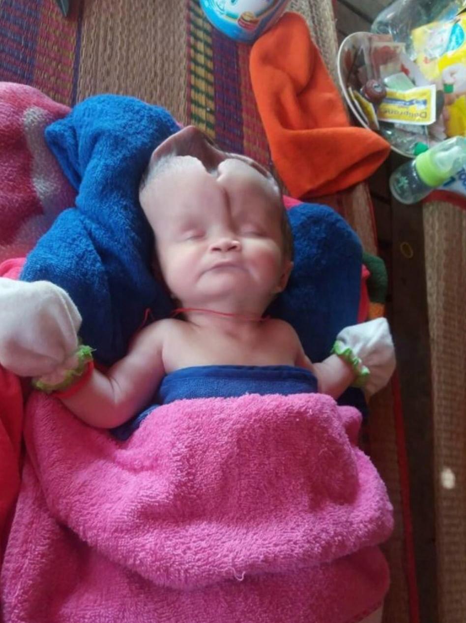 Baby girl born with half her skull MISSING defies the odds to survive